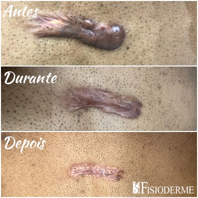 Aplicação de laser Picosure em queloide durante tratamento dermatológico