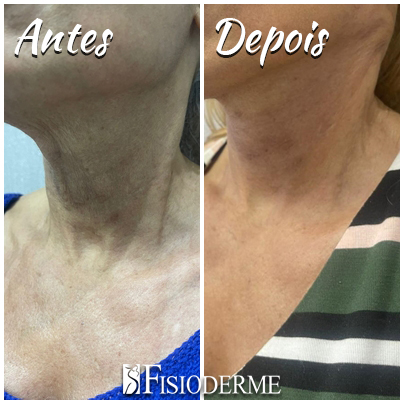 Lifting cervicofacial com fios - Clínica Fisioderme