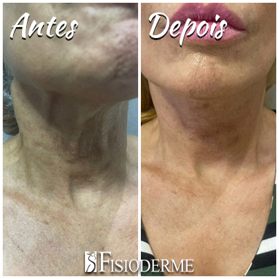 Lifting cervicofacial com fios - Clínica Fisioderme