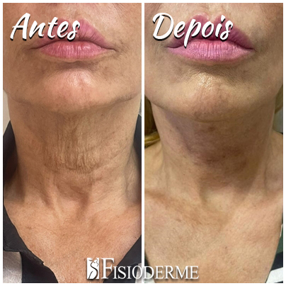 Lifting cervicofacial com fios - Clínica Fisioderme