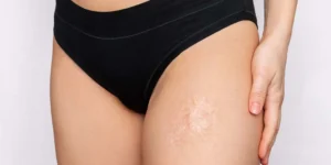 Paciente realizando tratamento a laser para cicatriz de queimadura na clínica Fisioderme