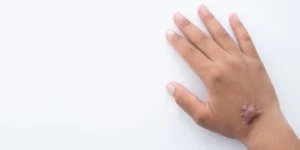 Aplicação de laser Picosure em cicatriz queloidiana durante tratamento dermatológico