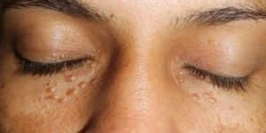 Tricoepitelioma - Clínica Fisioderme em Brasília / DF - Candangolândia e Asa Sul