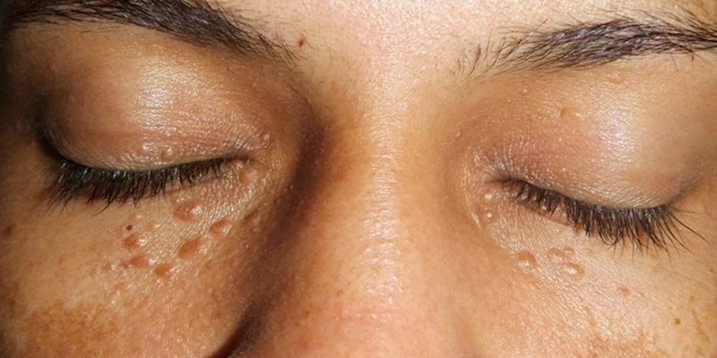 Tricoepitelioma - Clínica Fisioderme em Brasília / DF - Candangolândia e Asa Sul