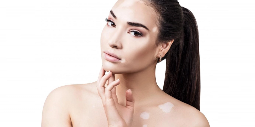 Vitiligo - Clínica Fisioderme em Brasília / DF - Candangolândia e Asa Sul