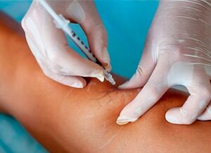 Diga adeus às microvarizes indesejadas com a Escleroterapia Química
