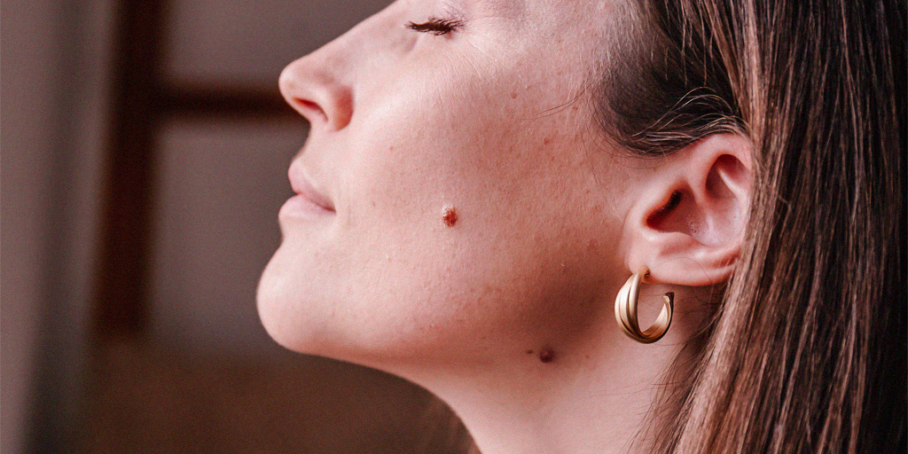 Paciente antes do tratamento de remoção de pintas na Clínica Fisioderme