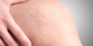 Aplicação de laser transdérmico em clínica de estética vascular em Brasília