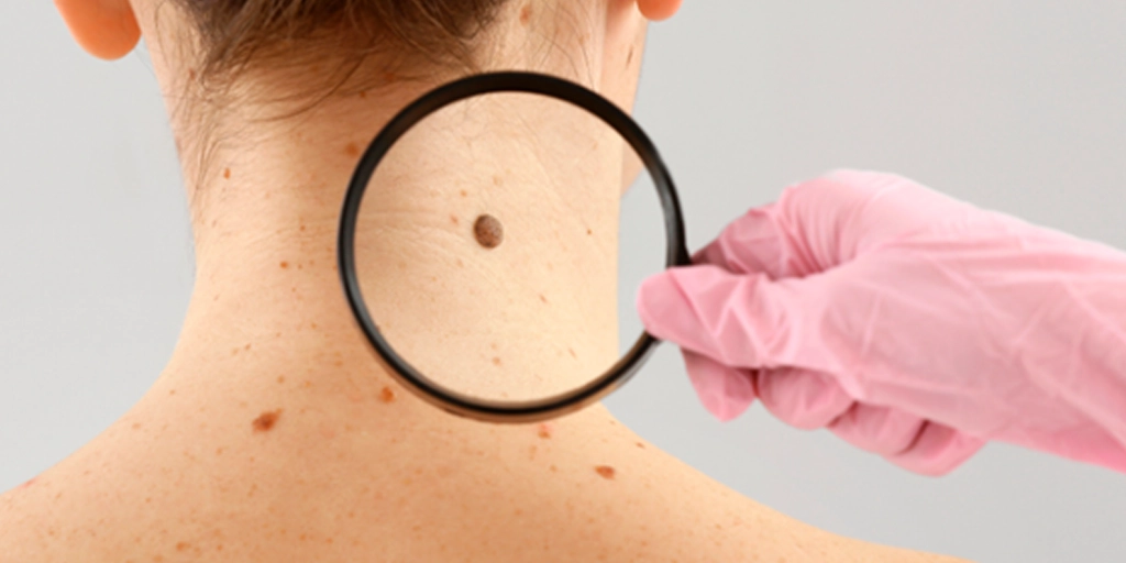 Paciente sorridente após tratamento seguro de remoção de pintas na Clínica Fisioderme