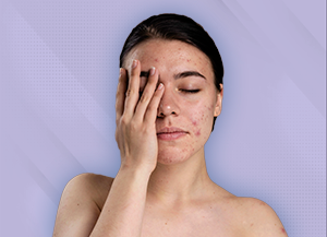 Um Guia Completo sobre Cicatrizes de Acne / Clínica Fisioderme / Brasília