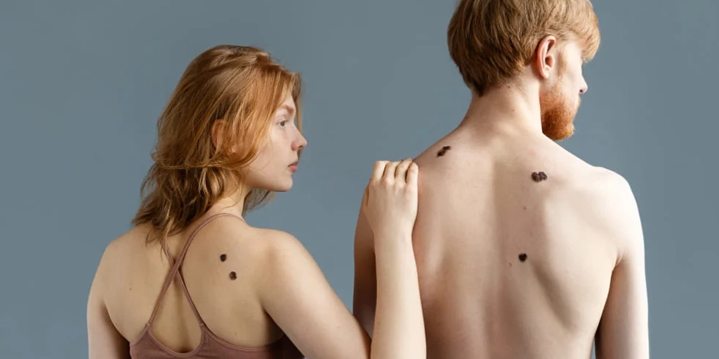 Nevo de Reed / Lesão Melanocítica Benigna - Clínica Fisioderme em Brasília / DF - Candangolândia e Asa Sul