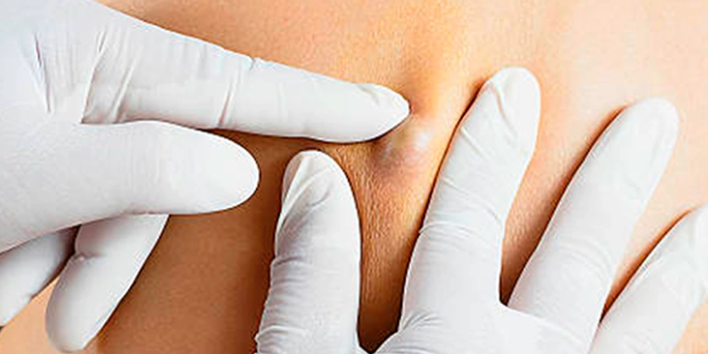 Cisto sebáceo inflamado na pele – aparência e localização típica