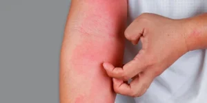 Revolucionando o Tratamento da Dermatite Atópica: Laserterapia e Ozonioterapia como Terapias Integrativas