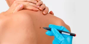 Sessão de remoção de verrugas e pintas com tecnologia laser em clínica dermatológica