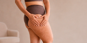Mulher com sintomas de lipedema