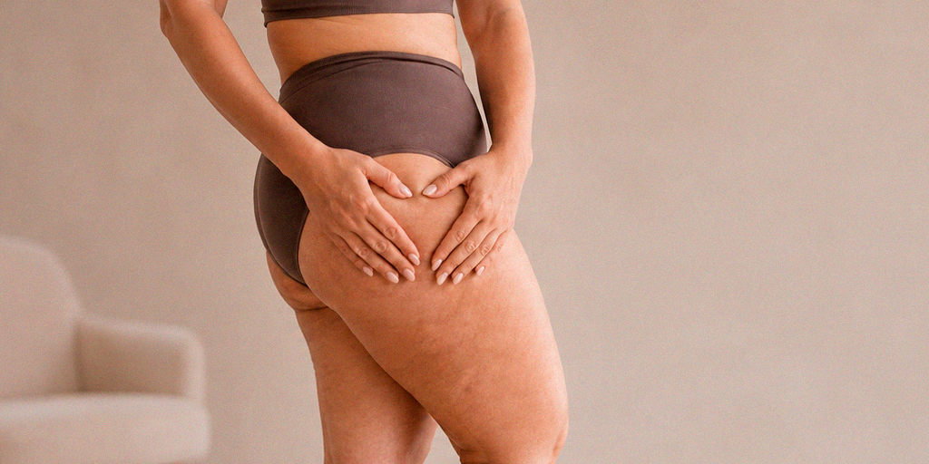 Mulher com sintomas de lipedema