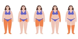 Mulher com sintomas de lipedema