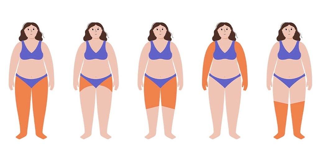 Mulher com sintomas de lipedema