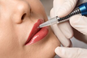 Antes e depois do tratamento Hidra Lips mostrando a diferença na hidratação, cor e efeito gloss dos lábios