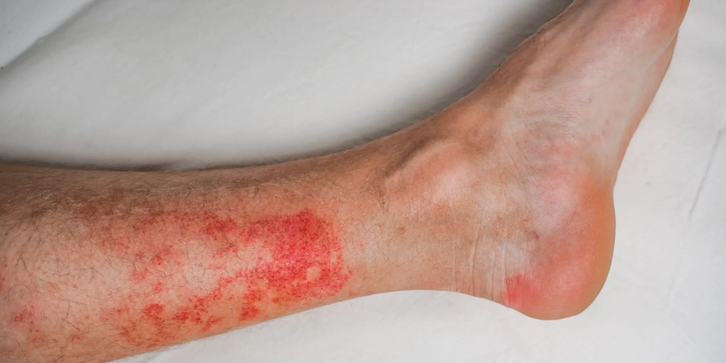 Erisipela - Clínica Fisioderme em Brasília / DF - Candangolândia e Asa Sul