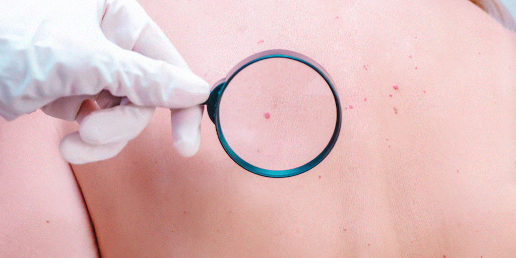Nevo Vascular ou Angioma Rubi: Você tem Pintas Vermelhas na Pele? - Clínica Fisioderme em Brasília / DF - Candangolândia e Asa Sul