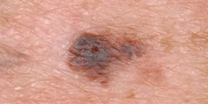 Nevo Spilus em Brasília DF – avaliação e remoção dermatológica