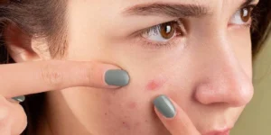 Cicatrizes e Manchas de Acne: Tratamentos Reais, Resultados Visíveis - Clínica Fisioderme em Brasília / DF - Candangolândia e Asa Sul