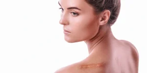 Tratamento a laser para cicatrizes na pele