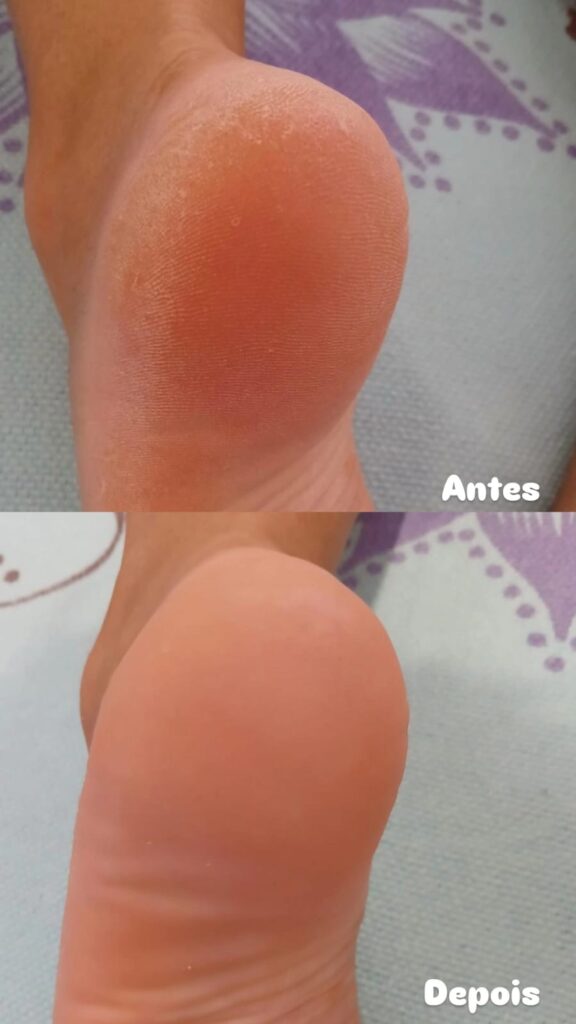 Tratamento de Plástica dos Pés em clínica especializada de Brasília com remoção de calos e rachaduras