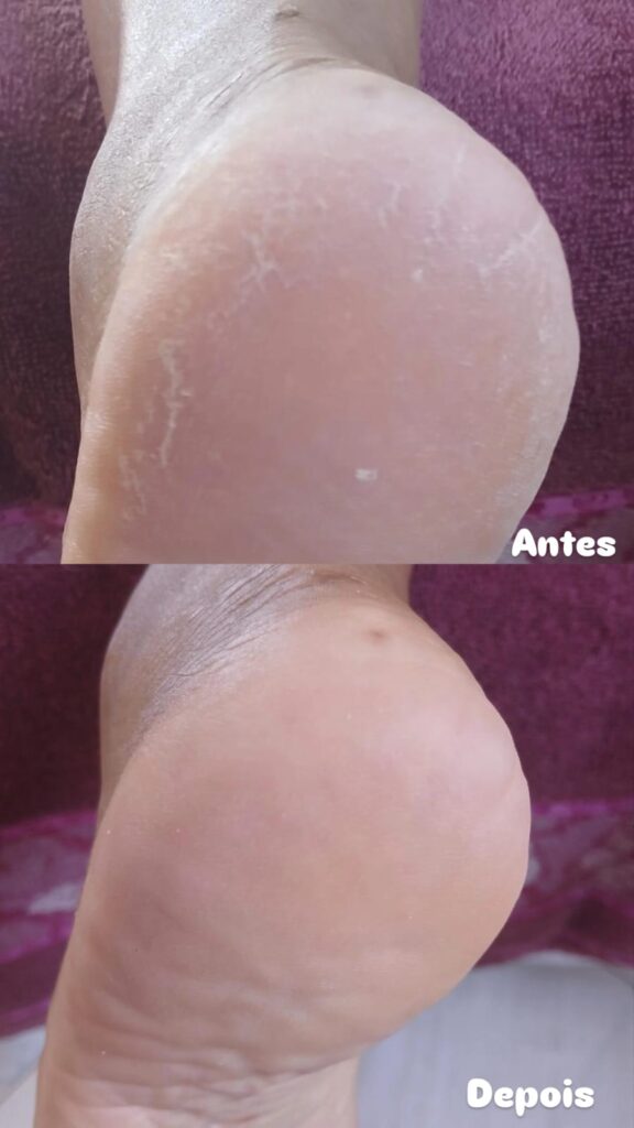 Tratamento de Plástica dos Pés em clínica especializada de Brasília com remoção de calos e rachaduras