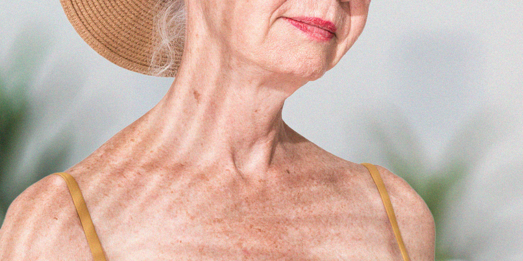 Tratamento de Melanose Solar / Melanose Senil na Clínica Fisioderme em Brasília