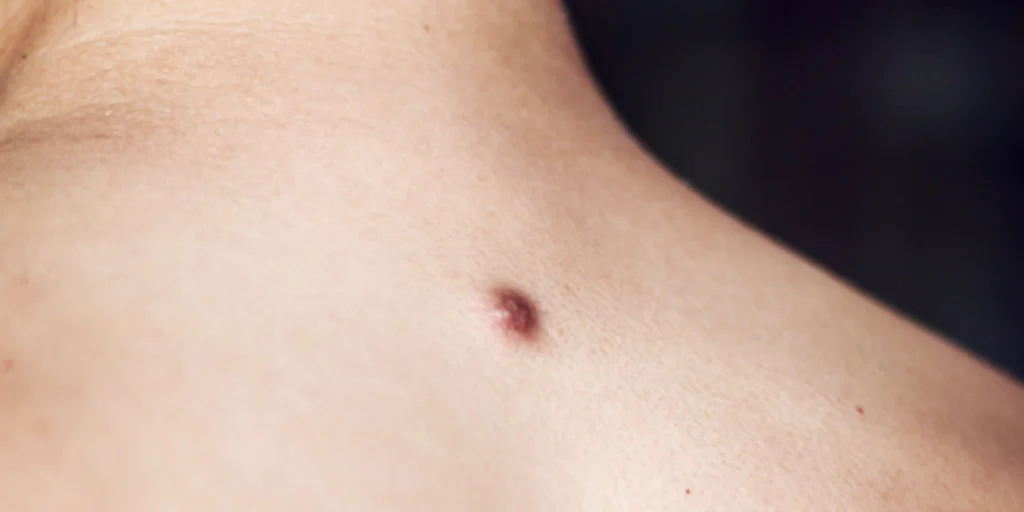 Dermatofibroma - Clínica Fisioderme em Brasília / DF - Candangolândia e Asa Sul