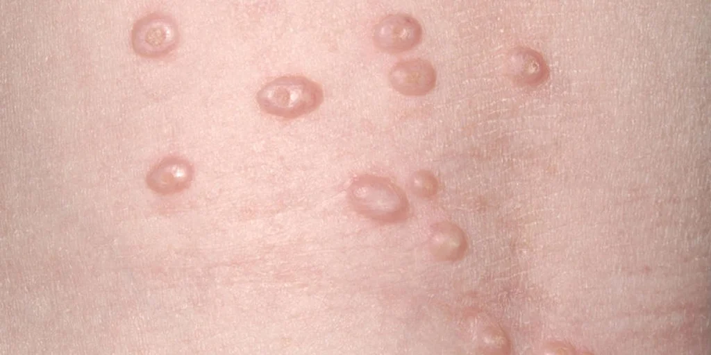 Molusco Contagioso - Clínica Fisioderme em Brasília / DF - Candangolândia e Asa Sul